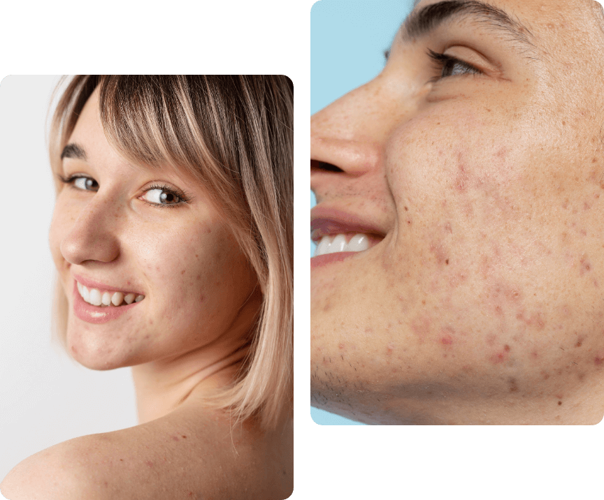 Acne Scar Treatment islamabad