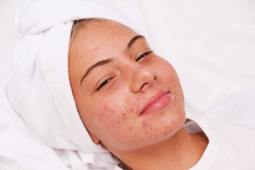 Acne Scar Treatment islamabad