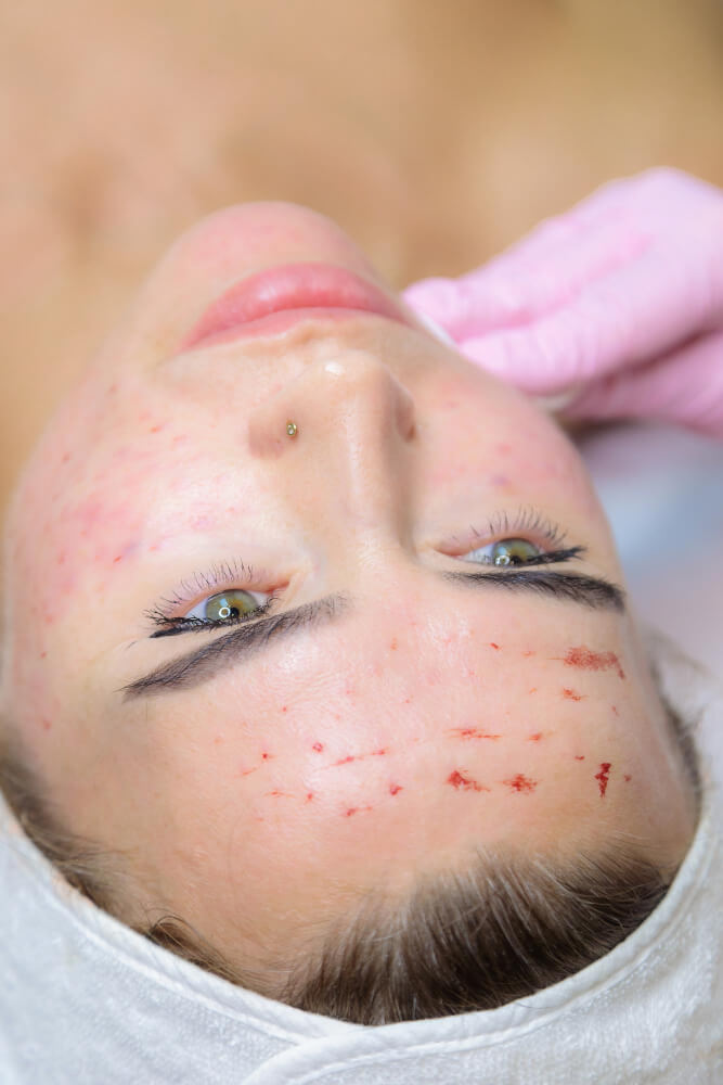 Acne Scar Treatment islamabad