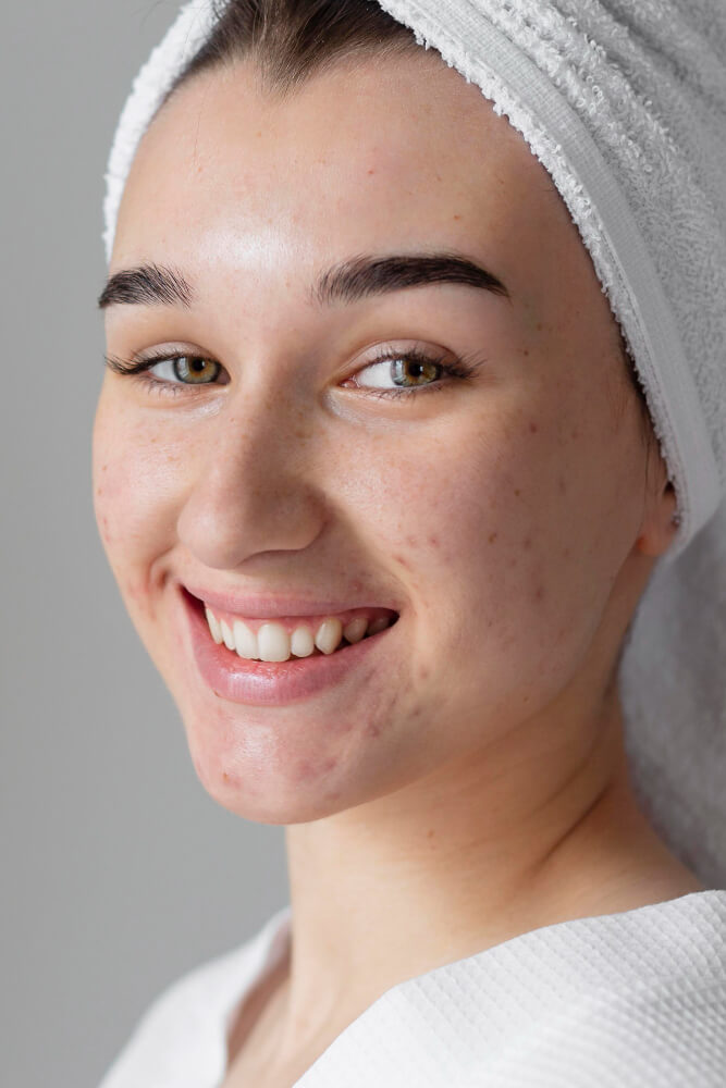 Acne Scar Treatment islamabad