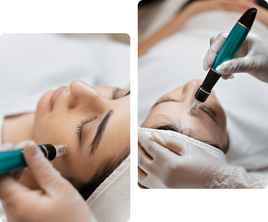 PICO Skin Treatment Islamabad