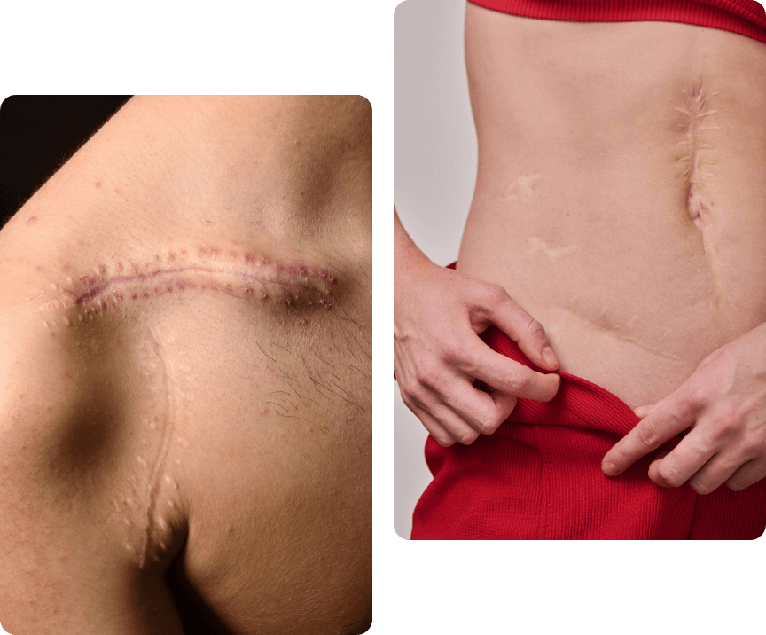 Post-Surgical Scar Treatment