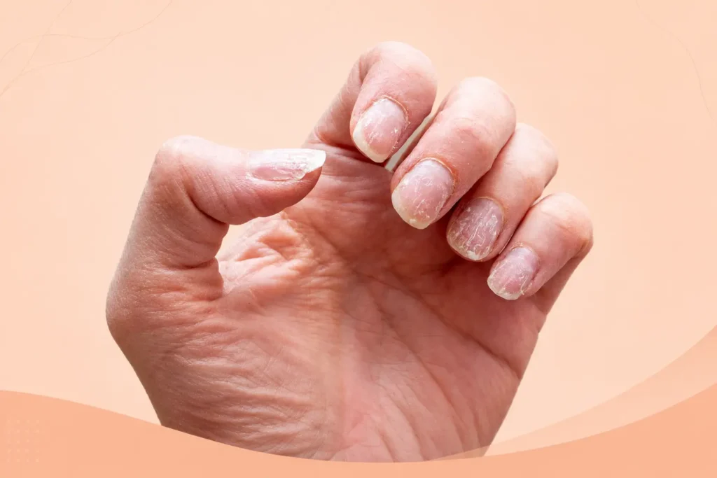 Affordable nail disorder treatment in Islamabad at Dermalase F-10 by Dr. Shumaila Khan. Book your consultation today for healthier nails.