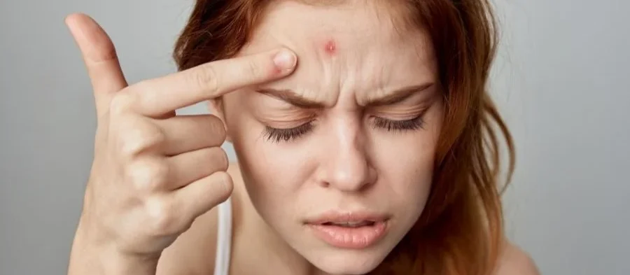 Acne treatment in Islamabad by Dr shumaila khan